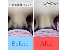 リリアン 周南店(Lillian)/うなじビフォーアフター