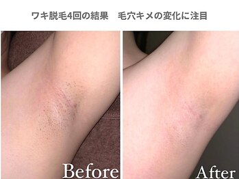 ピュアノア 三木店/ワキ|全身脱毛　三木|小野|西脇