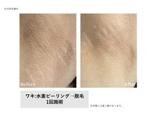 トータルクリア(TOTAL CLEAR)/水素ピーリング×光脱毛