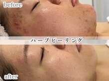 ミック(Mecc)の雰囲気(肌状態を見極め優しく入れ込むオーダーメイドハーブピーリング)