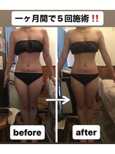 アンリール 旭川店(Anrire)/１か月のビフォーアフターです！