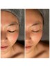 たるみ改善・小顔【速攻小顔ダイアモンドコース】小顔/たるみ/美肌¥10,000