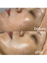 シロ(SHIRO)/ハーブピーリング