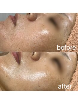 シロ(SHIRO)/ハーブピーリング