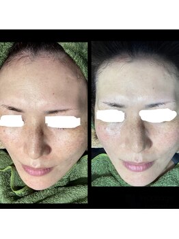 ココスタイルビューティー(COCOSTYLE beauty)/シミケア