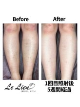 ルリアン(Le Lien)/【レディース】足症例