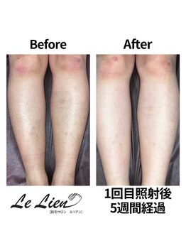 ルリアン(Le Lien)/【レディース】足症例