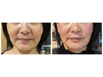 ねこのひげ/50代女性顔の変化