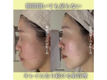 ハニエル(Haniel)/カーボキシー症例