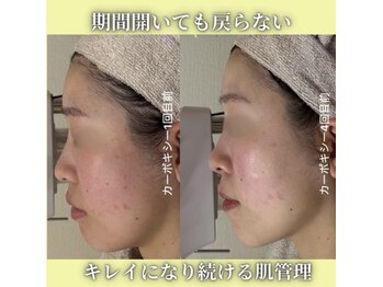 ハニエル(Haniel)/カーボキシー症例