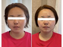 ニコワ(Nicowa)/Nicowaのコルギ★BeforeAfter