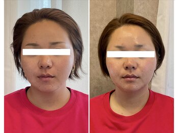 ニコワ(Nicowa)/Nicowaのコルギ★BeforeAfter