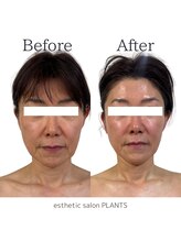 プランツ(PLANTS)/60代／１回／たるみ改善・小顔