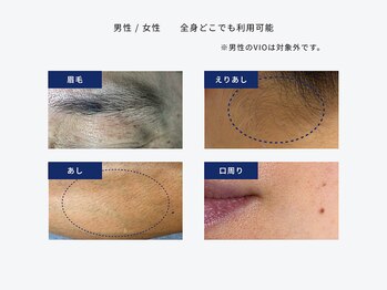 ノルテ(NOLTE)の写真/＼NEW OPEN◇電気脱毛／光脱毛では難しい 眉毛・VIO・指・脇など細やかな部分も、1本ずつ徹底ケア◎