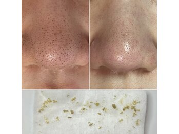 しらゆき 名古屋黒川/毛穴エクストラクション