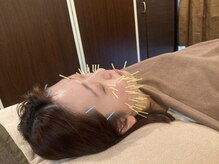 アキュティ 吉祥寺(Acuty)/小顔美容鍼