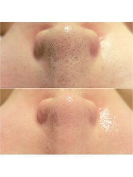 サロンドリー(salon de Re)/お顔全体の毛穴洗浄