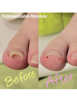 ニコルル 高崎パルクハナミズキ店(Nicolulu)/巻き爪補正