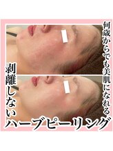 エクラーレ(Eclale)/ハーブピーリング症例