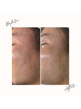 イチロクイチハチ(1618)/#鎮静 #乾燥肌 #栄養補給#保湿