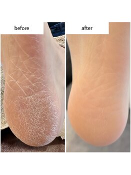 ケアプラス(care plus)/足裏角質ケア