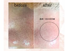 シェリール(cherir)/黒ずみ撲滅★