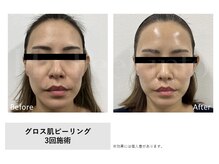 ティーナ(Teena)/ビフォーアフター