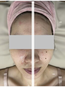 ハナ トータル ケア(Hana Total Care)/LDM水玉リフティングの効果