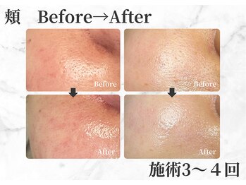 セレーノ 白金台(seReno)/潤艶ワックス 頬before/after