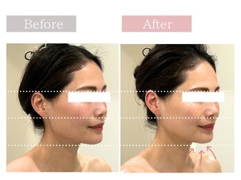 フロリール アザブジュウバン(FlorirAzabujuban)/3D小顔/造顔フェイシャル50分