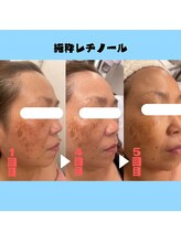 ベルローズ ラパーク 金沢店/フェイシャルビフォーアフター