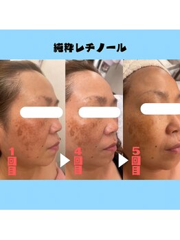 ベルローズ ラパーク 金沢店/フェイシャルビフォーアフター