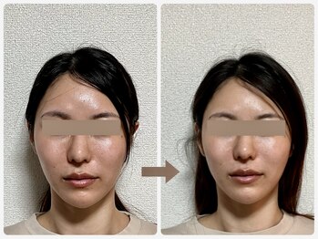 哲心 姫路/一度の施術でお顔の悩みを解消♪