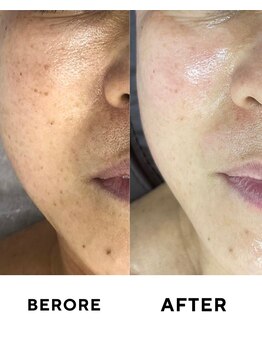 ゼロ 水戸店(ZERO)/シミ・シワ肌質改善スペシャル