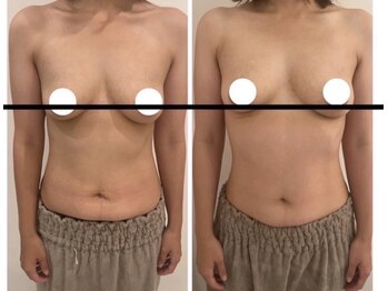 美人バスト 南森町店/バストアップ◇症例◇