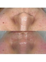 サロン クベル(Salon Kvell)/フェイスワックス