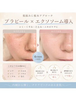 サロンシー(salon C)の写真/【毛穴のお悩み!肌質改善にも◎】韓国で人気の肌管理メニュー!プラピール・ララピール☆エクソソーム導入
