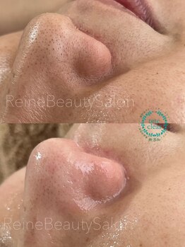 レーヌ(Reine)/毛穴エクストラクションフォトRF