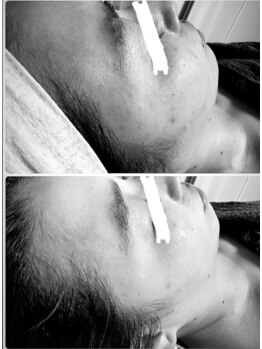 アシスト(Assist)/ララピール