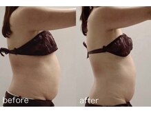 ワイグレイス(Y.GRACE)/ヴィーナスディーバ（4D痩身）