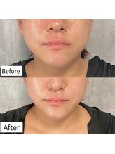 ヒカリエステ 六本木(HIKARI ESTHE)/切らない小顔リフト