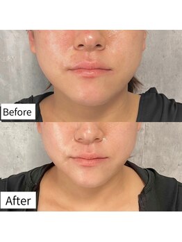 ヒカリエステ 六本木(HIKARI ESTHE)/切らない小顔リフト