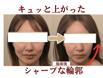 メディカモン(medikamon)/小顔矯正でシャープな輪郭へ