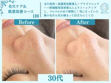 フローフシ∞/【毛穴洗浄】毛穴の詰まり改善