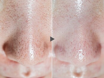 クリード(CLEAD)/ハイドラフェイシャル/毛穴洗浄