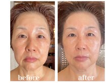 ルー ハナレ 神戸岡本 摂津本山店(Luu HANARE)/3回 小顔リフトアップ　しわ改善