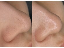 サロン キュー(Salon Cue)の雰囲気（【ハイドラ毛穴洗浄】黒ずみをごっそり吸引◎毛穴レス肌へ）