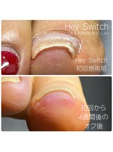 ルアナネイル(Luana Nail)/HeySwitch～巻き爪緩和ジェル～