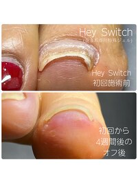 HeySwitch～巻き爪緩和ジェル～