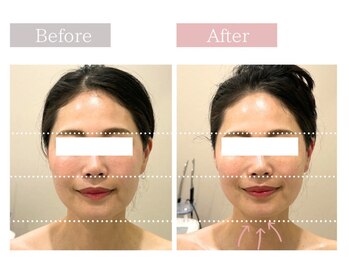 フロリール アザブジュウバン(FlorirAzabujuban)/3D小顔/造顔フェイシャル50分